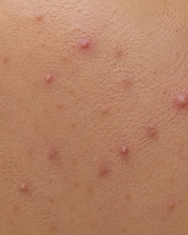 Acne Prone Skin