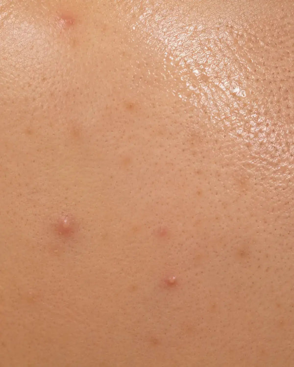 Combination Skin