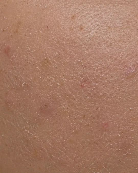 Damaged / Stressed Skin