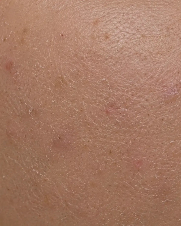 Damaged / Stressed Skin