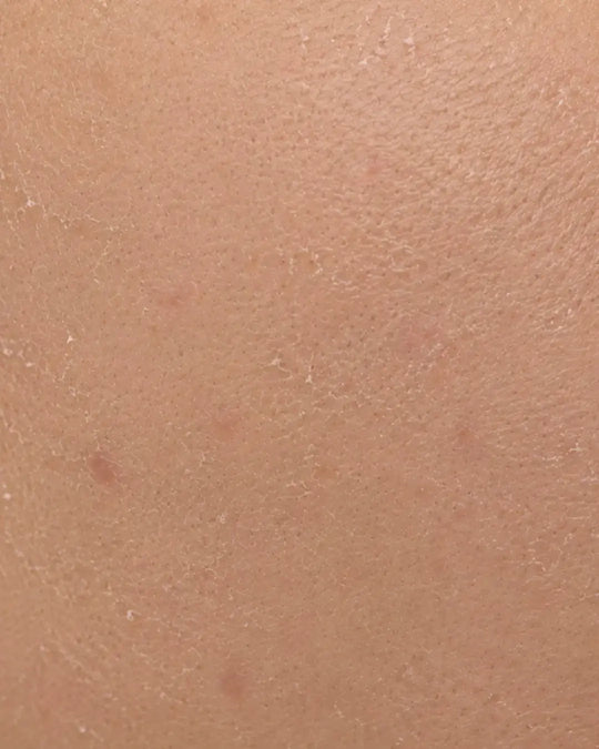 Dry & Dehydrated Skin