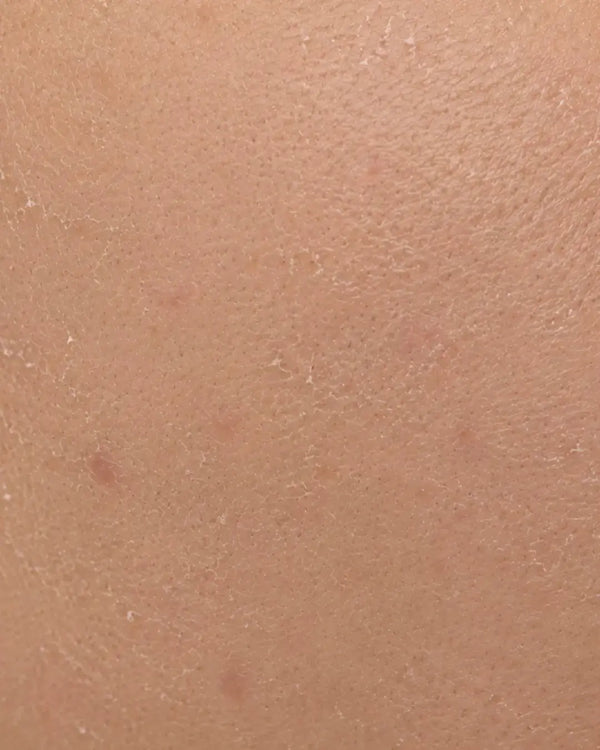 Dry & Dehydrated Skin