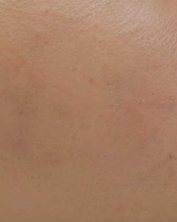 Dull & Tired Skin