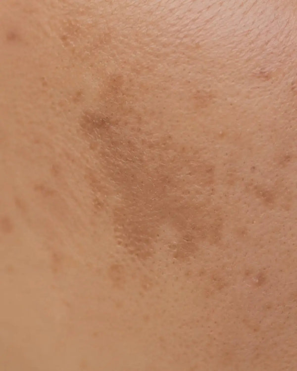 Pigmentation / Uneven Skin Tone
